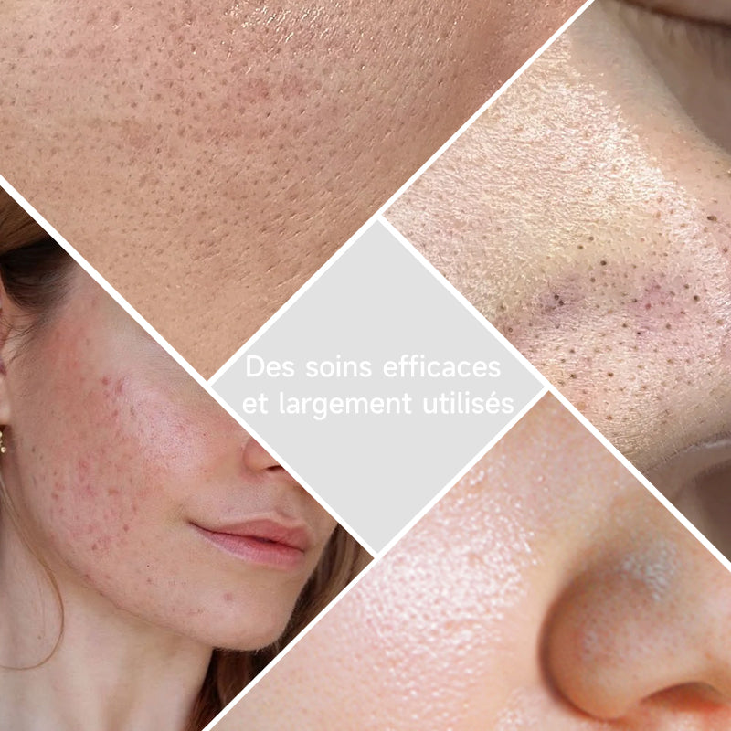 Qiweiny Appareil 2-en-1 extracteur de points noirs & grattoir visage vert